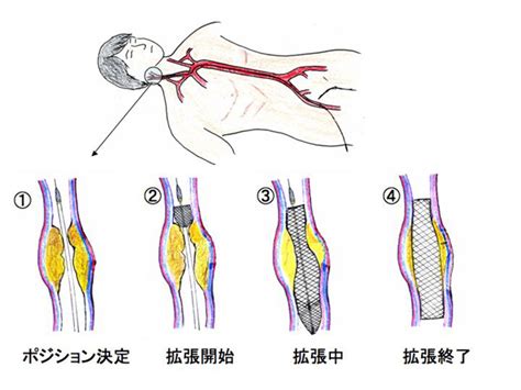 首 脈|頸動脈狭窄｜慶應義塾大学病院 KOMPA